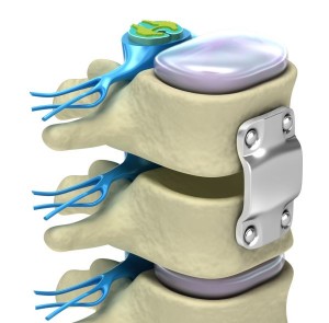 Spinal Injuries